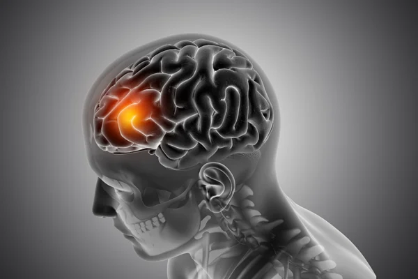 Right Hemisphere Damage
